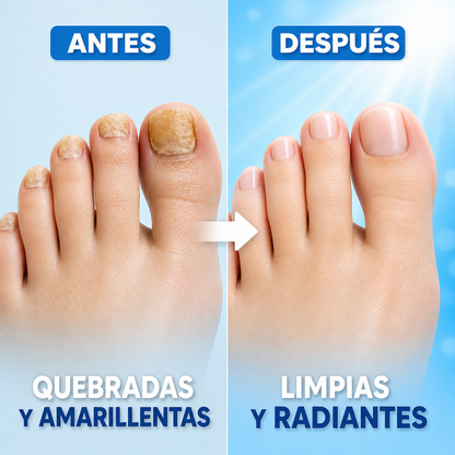 NailLaser Pro Láser para Hongos en las Uñas