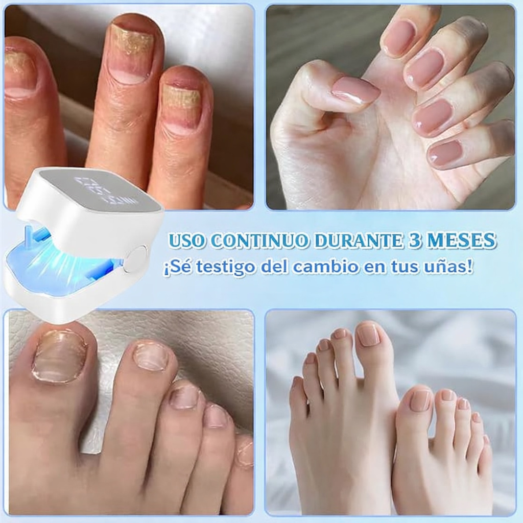 NailLaser Pro Láser para Hongos en las Uñas